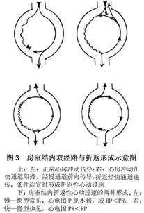 室上性心动过速时,折返可发生在窦房结与邻近心房肌间,心房内,房室结