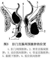 (2)按脓肿部位分类:①肛提肌下脓肿(低位脓肿):包括肛周皮