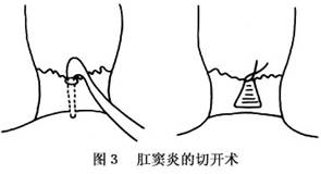 肛窦炎及肛乳头炎