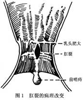 前哨痔是因淋巴淤积于皮下所致,似外痔,由于在检查时因先看到此痔而后