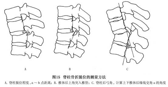 测量:①椎体压缩程度;②脱位程度;③脊柱后弓角,正常胸椎后弓角不10