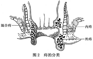 其表面呈暗红或紫红色,由海绵状组织与肛管括约肌紧密相连,其内部为