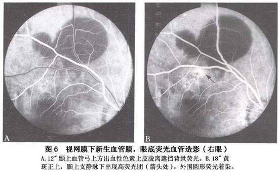 脉络膜新生血管膜形成