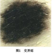 为平坦或高出皮面,或呈疣状或有蒂状,直径通常在1cm以内,呈棕色或黑色
