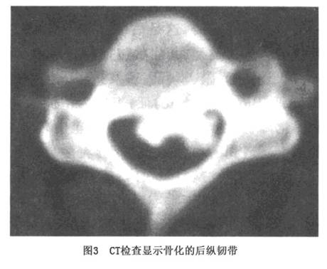 颈椎后纵韧带骨化