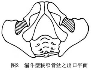 中骨盆-出口狭窄而入口面正常的漏斗型狭窄骨盆,胎头多能衔接入盆