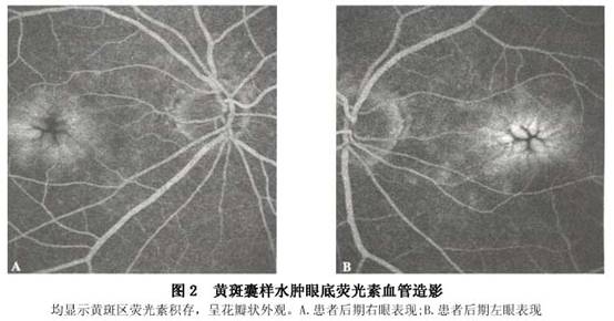 黄斑囊样水肿