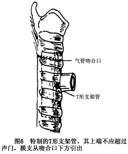 (2)胸段气管损伤:胸段气管破裂的修补和颈段一样,麻醉师的配合