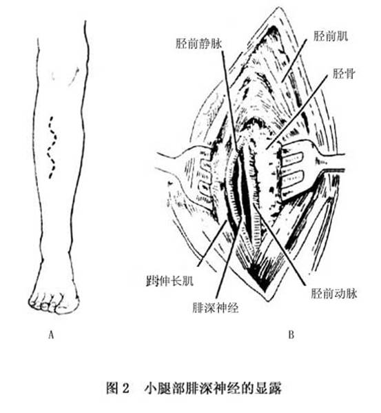 腓总神经损伤