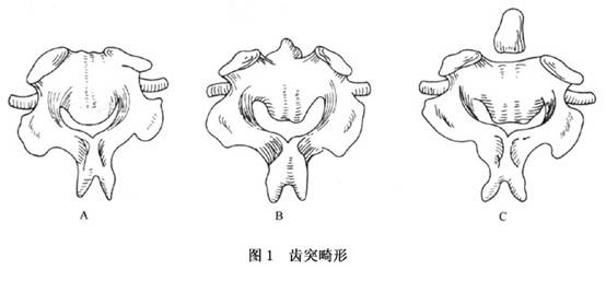 上颈椎不稳症