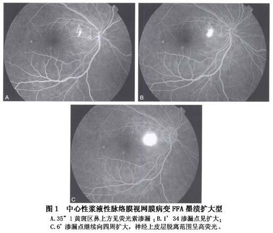 荧光素眼底血管造影  ffa是确诊中浆的必不可少的手段,也是激光治疗