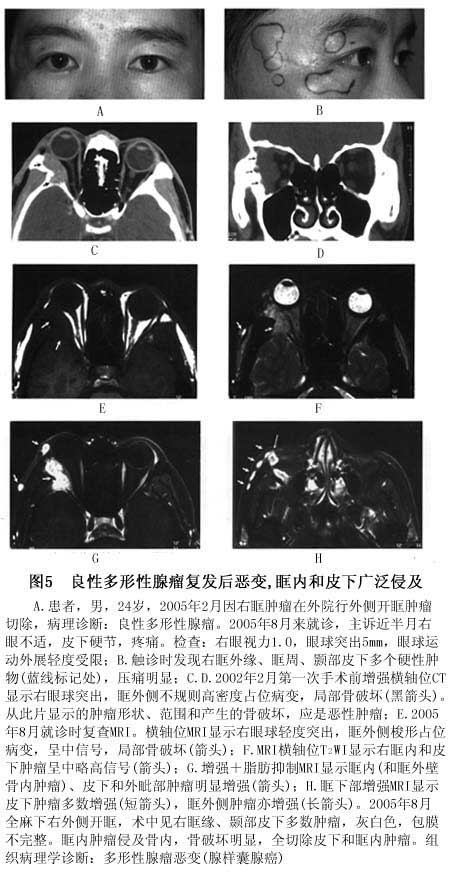 疾病早期即可有严重眶周及结膜水肿,由于肿瘤呈浸润性生长,沿血管