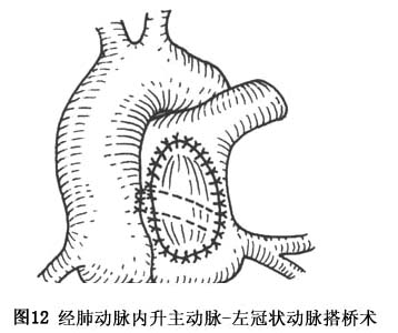 移植术(图13):此术式适用于左冠状动脉起自肺动脉干后壁或左肺动脉