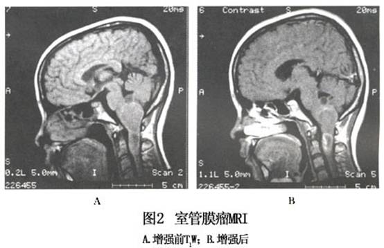 间变性室管膜瘤在ct与mri上强化明显,肿瘤mri表现t1w为低信号,t2w