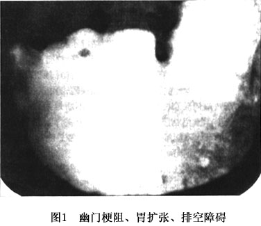 幽门梗阻