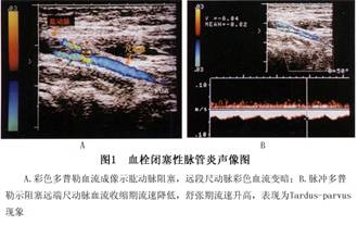 闭塞性血栓性脉管炎