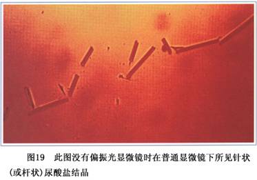 光学显微镜检查的阳性率仅为偏振光显微镜的半数.