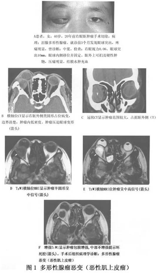 多形性腺癌的临床表现类似多形性腺瘤,但病程短,泪腺恶性肿瘤的病程