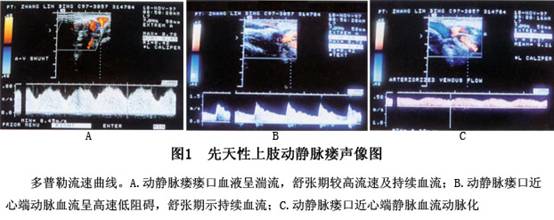 先天性动静脉瘘