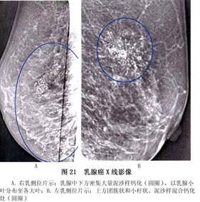 乳腺癌