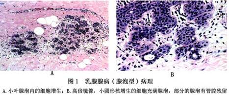 为腺病的早期形态,主要为乳腺小叶增生,小叶内导管及腺泡均增生,数目