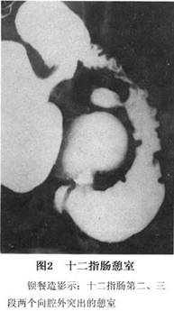 x线钡餐检查  可发现十二指肠憩室,表现为突出于肠壁的袋状龛影,轮廓