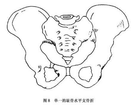 由于单一的耻骨支或坐骨支骨折无损于骨盆环的完整与稳定,一般
