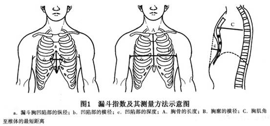 不对称凹陷以右侧凹陷较深多见,胸骨体腹面转向右侧,严重时可旋转90°