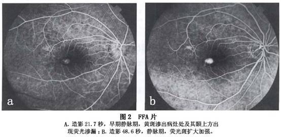 介绍(3)瘢痕期:病灶面视网膜水肿消失,成为境界清楚的灰白色斑块