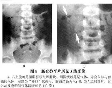 偶可在腹部平片见到肠套叠直接征象,如在右下或右腹部