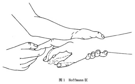 (2)出现病理反射:以hoffmann征(图1)及掌颏反射出现的阳性率为最