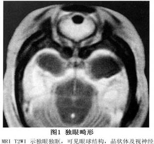 先天性小眼球合并眼眶囊肿