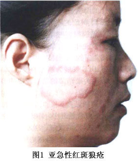 ①acle:绝大部分患者表现为典型的"蝶形红斑"或颧部皮炎.