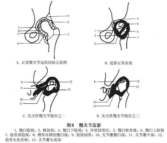 先天性髋关节脱位