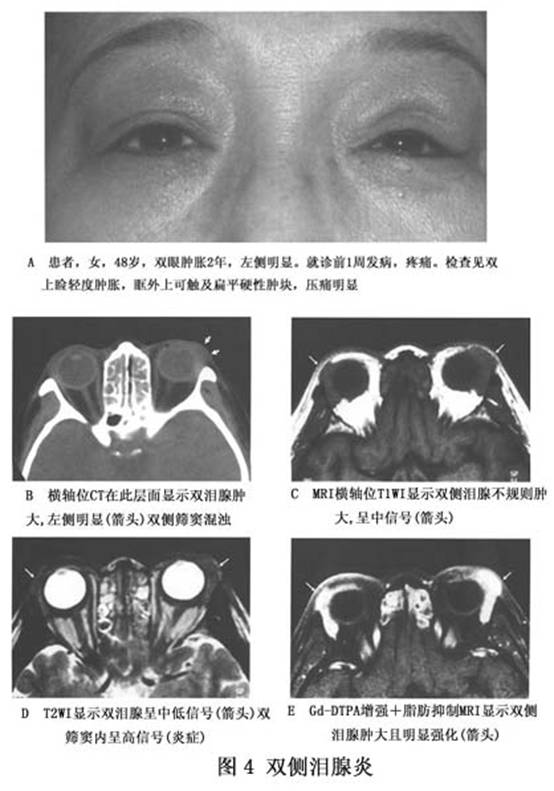 泪腺炎