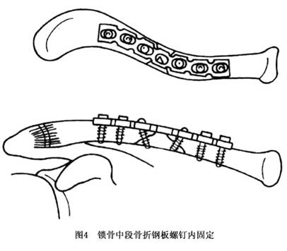 锁骨骨折