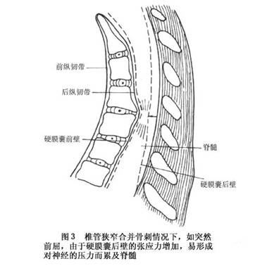 ②中度椎管狭窄者:指椎管矢状径在10～12mm者,凡经正规非手术