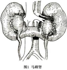 马蹄形肾是最常见的融合肾畸形,两肾下极由横越中线的实质性