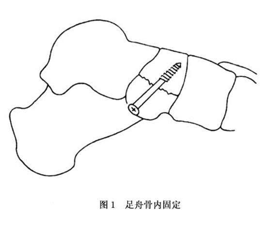 足舟骨骨折