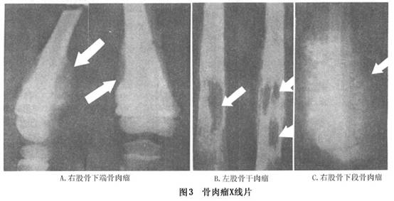 常见的x线表现为侵袭性溶骨病损,同时有肿瘤骨的形成,表现为不同