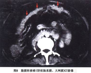 以上3种表现可同时存在,细点污垢状的大网膜或肠系膜可增大为结节