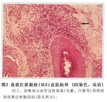 盘状红斑狼疮