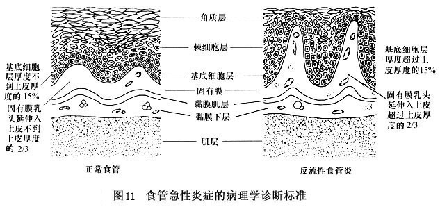 食管黏膜活检  食管黏膜活检和细胞学检查对评价gerd病人的价值有限