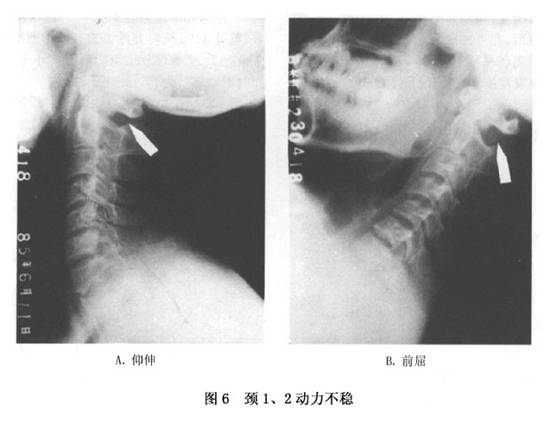 上颈椎不稳症