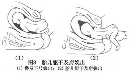 随宫缩的加强,入盆时胎儿股骨大粗隆间径,衔接于骨盆左斜径,胎臀逐渐