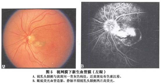 脉络膜新生血管膜形成