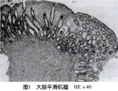 结肠平滑肌瘤