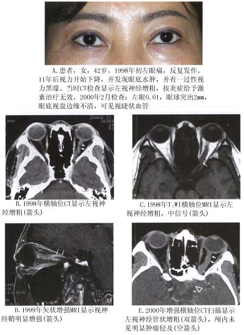 增强mri 脂肪抑制是显示视神经鞘脑膜瘤尤其是怀疑向颅