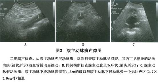 (1)二维超声:①夹层动脉瘤声像特点:纵断面显示腹主动脉外径较