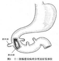 好发部位 十二指肠憩室以单发性多见,多发性的很少.